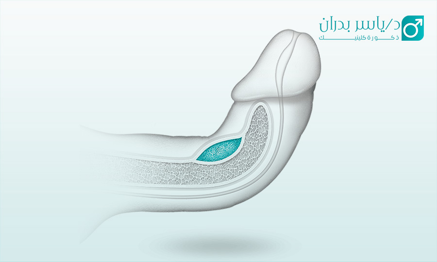 هل مرض بيروني له علاج علاج مرض بيروني بالموجات التصادمية